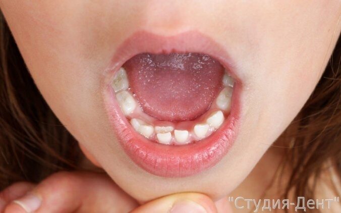 Классификация гипоплазии зубной эмали у детей