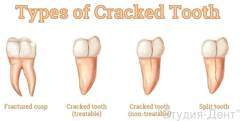 Сломался зуб или откололся кусок? Методы восстановления и лечения — ROOTT